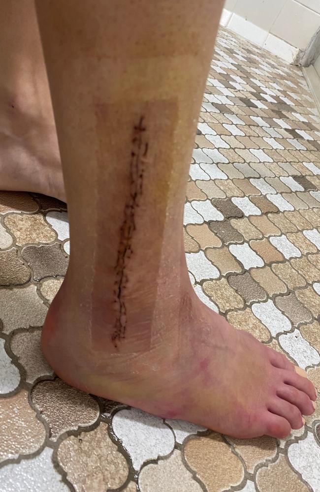 Jessica Powell's ankle had to be reset and her ligaments restitched after her shocking injury suffered in a club game playing with Rockhampton Brothers.