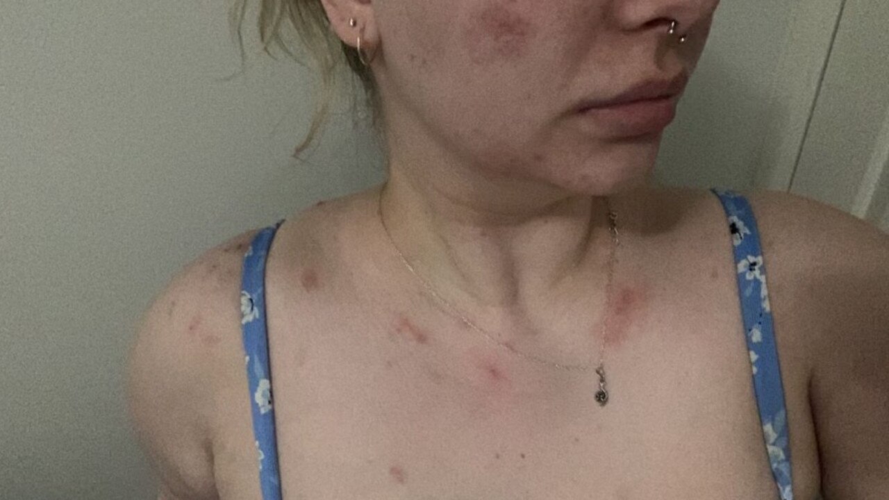 Leilah said eczema has impacted her health and confidence. Picture: Supplied