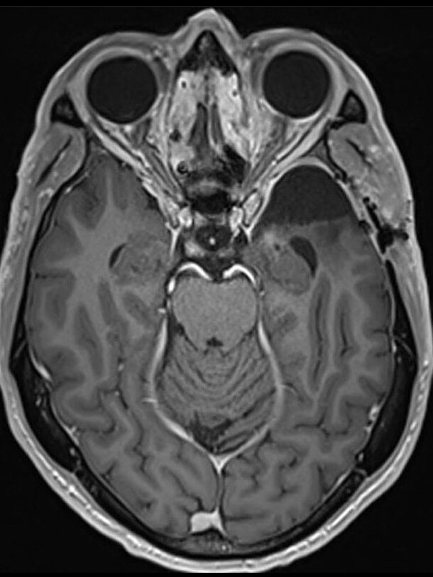 Australian of the Year Professor Richard Scolyer’s MRI brain scan. Picture: Instagram