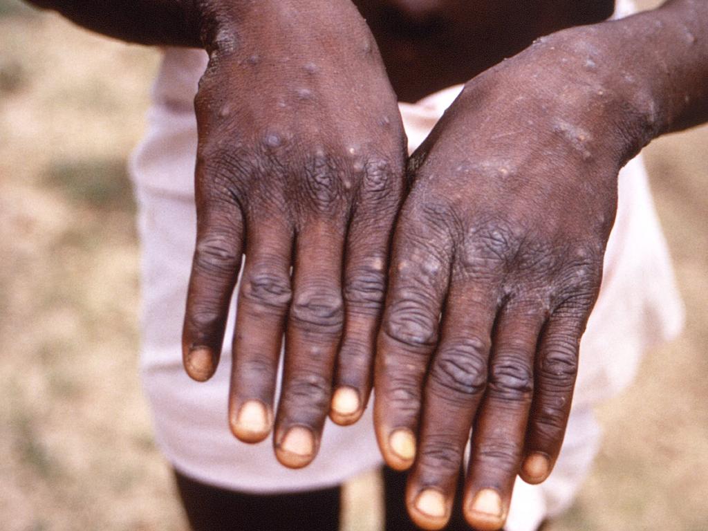 Most people who contract monkeypox make a full recovery within weeks without the need for treatment. Picture: AFP / Brian W.J. Mahy / Centers for Disease Control and Prevention