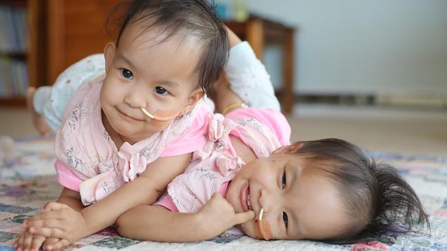 Bhutanese conjoined twins Nima (left) and Dawa (right) before their surgery. Picture: Alex Coppel