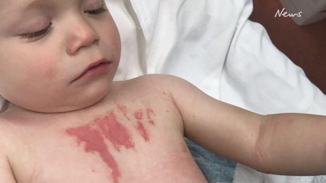 How a mum reacts when her child suffers burns