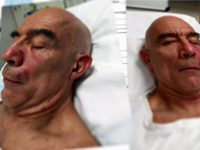 Andrew Nerlich suffered a number of facial injuries in the attack. Picture: Channel 7