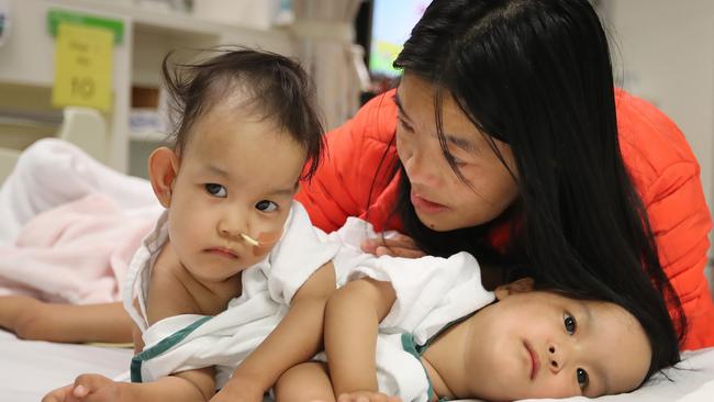 Conjoined twins, Nima and Dawa, are prepped for their separation surgery at the Royal Children’s hospital. Picture: Alex Coppel