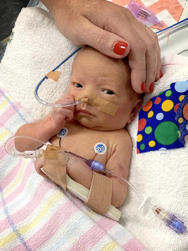 Jack Burke has had three major surgeries after being born with his heart on the right side of his chest.