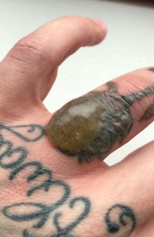 Tattoo removal gone wrong: Treatment leaves man with swollen blister |   — Australia's leading news site
