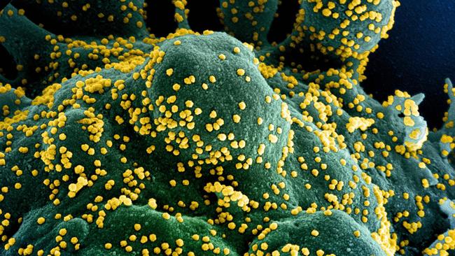 A colorised scanning electron micrograph of an apoptotic cell (blue/green) heavily infected with SARS-COV-2 virus particles (yellow), isolated from a patient sample, ) in Fort Detrick, Maryland. - Photo National Institute of Allergy and Infectious Diseases/AFP