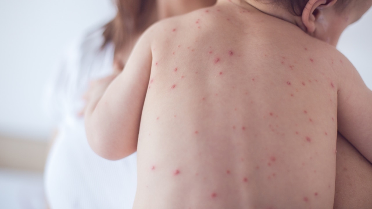 ‘Worth protecting everyone’: Measles outbreak side effects ‘a real concern’