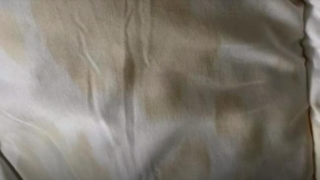 Stains on hotel bedding. Picture: Four Corners