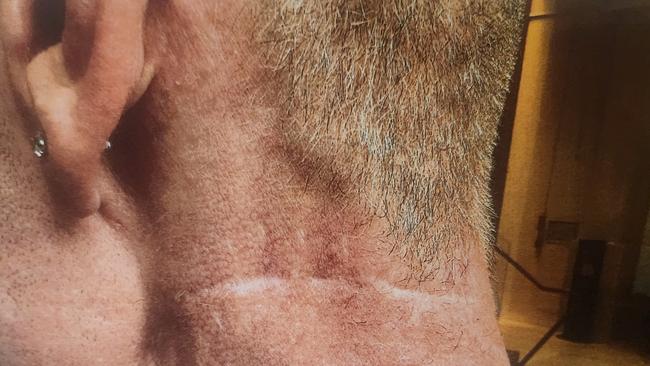 The scar Mr Whitehead was left with after the attack by Mr Robinson. Photo: Courts SA