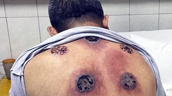 Viral Photos Show Shocking Marks from a Popular Alternative to Cupping