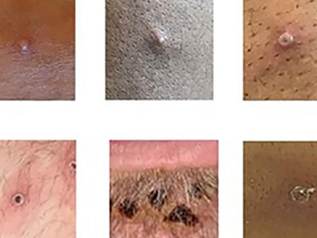 This file handout picture made available by the UK Health Security Agency shows a collection of monkeypox rash lesions. Picture: Handout / UK Health Security Agency / AFP