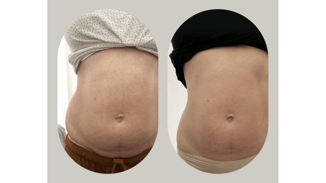 Before and after using the Body Sculpt Cup. Image: Supplied