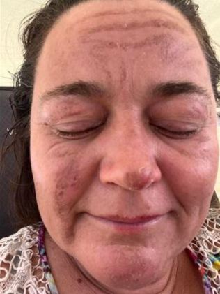 The explosion left Samantha with nasty burns across her face. Picture: Supplied