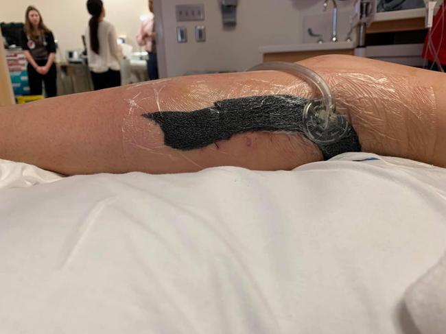 Girl gets flesh-eating virus on familuy holiday. Picture: Michelle Hill