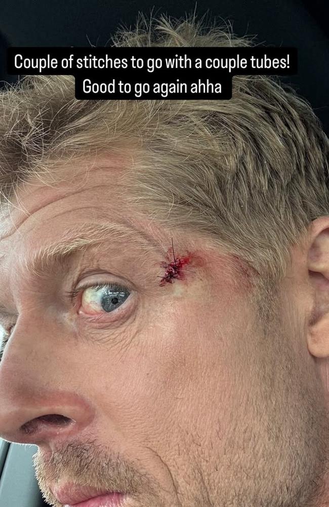 Surfing legend Mick Fanning wouldn't miss Alfred's swell for anything – not even a busted eye. Picture: Instagram/@mfanno