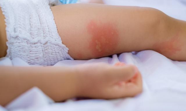 Is Your Child Allergic To Mosquitoes Dr Sam Hay Kidspot