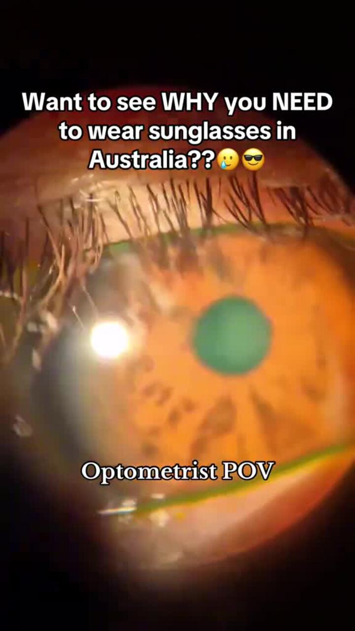 Optometrist shows how UV ‘cooks’ your eyes