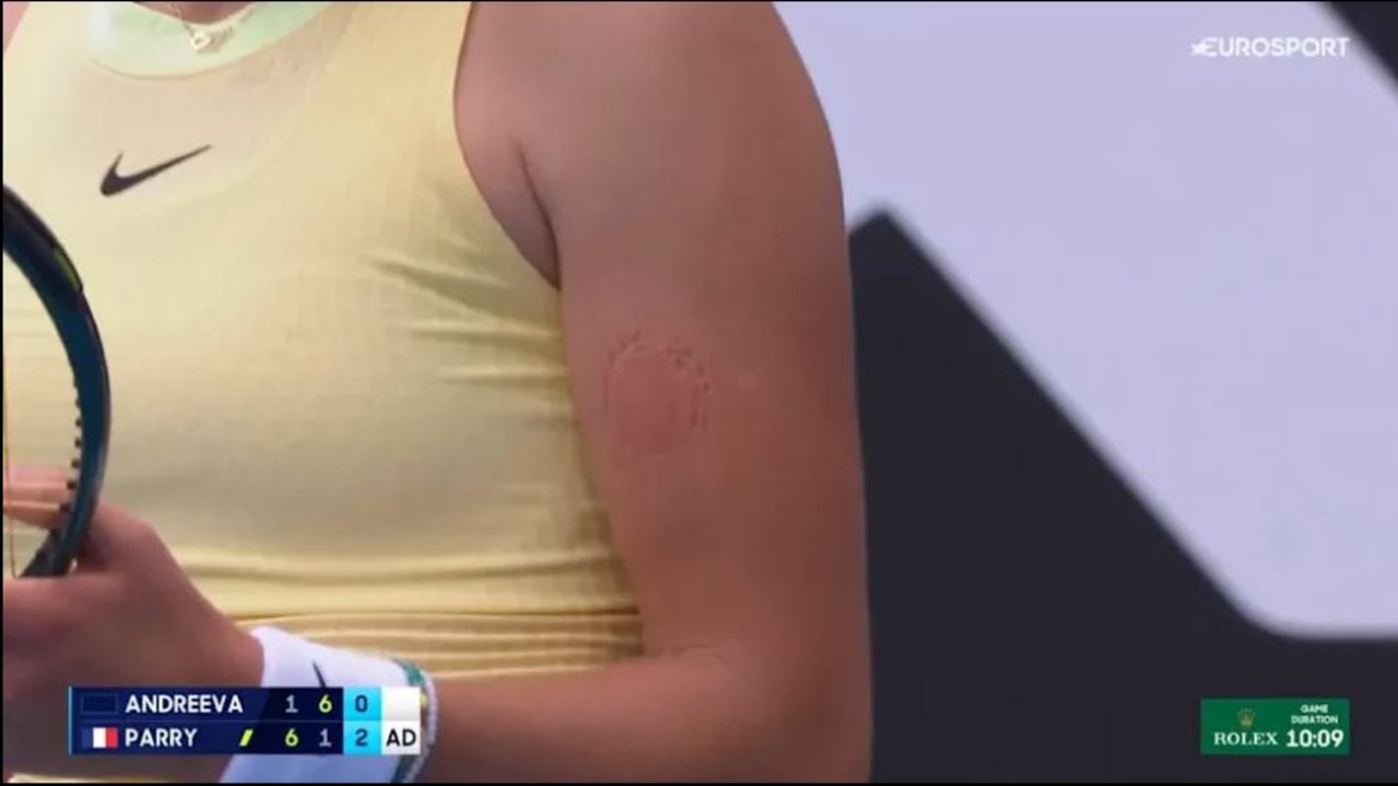 A bite mark could be seen on the young star's left arm.