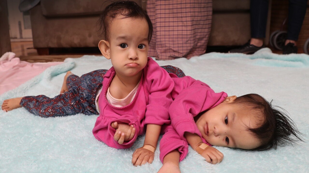 Separation Surgery For Bhutanese Conjoined Twins Confirmed For Friday