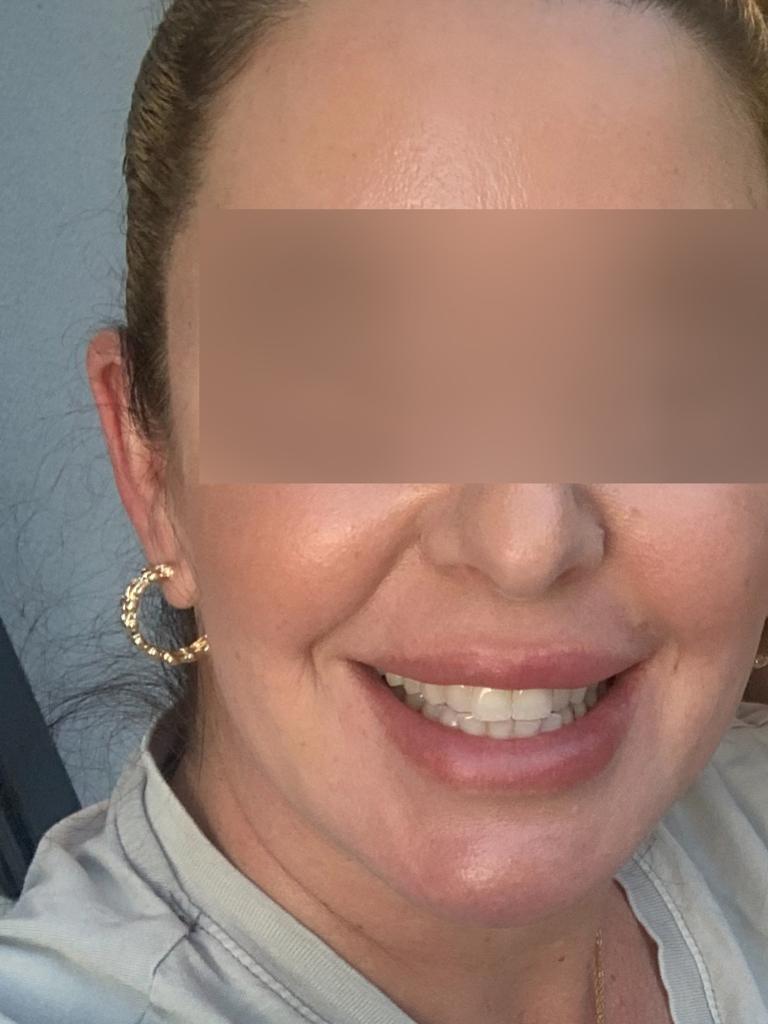 Sarah’s skin before the treatment. Picture: Supplied