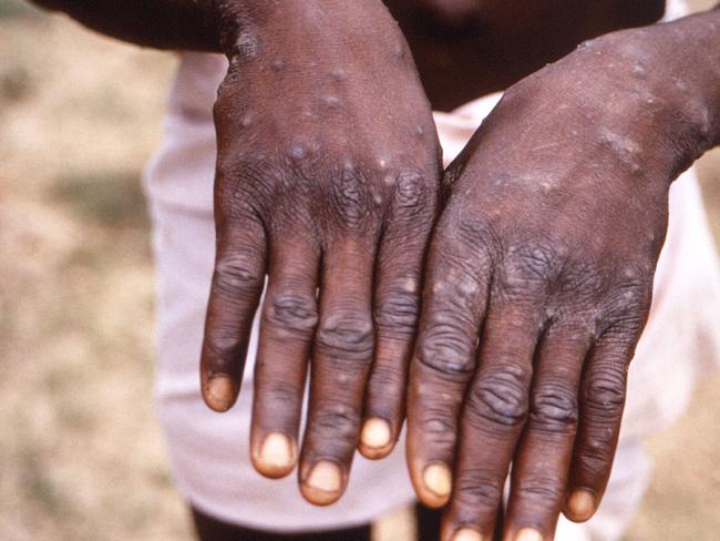 Monkeypox emergency: what it means for Aussies