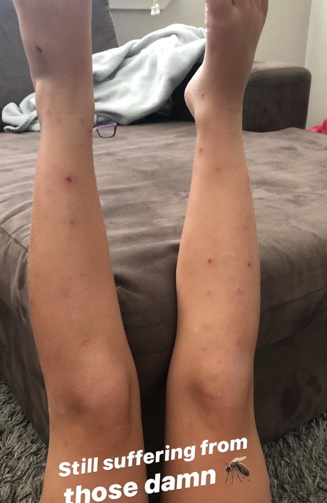 Seven-year-old Kylah Ferguson has been left "scarred for life" by mosquito bites she sustained while sleeping and going to school. Picture: Shae Ferguson