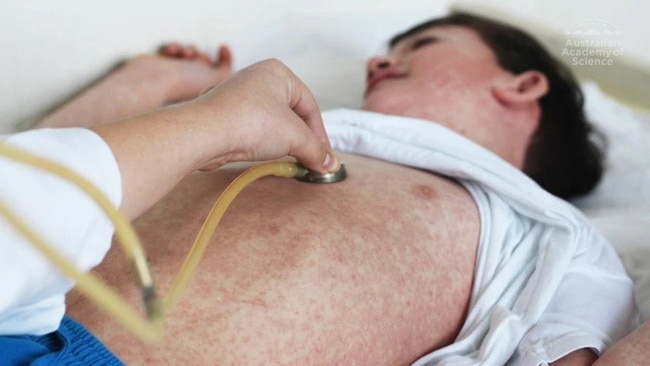 More measles cases have been detected in the Gold Coast and in greater western Sydney. Picture: Supplied / ACS