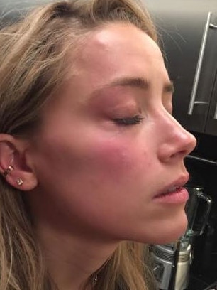 A photo showing Amber Heard with a reddened face was released by a London court. Picture: Supplied