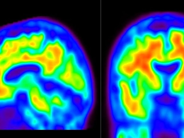 A PET brain scan showing amyloid plaque in the brain of a person with Alzheimer's disease.