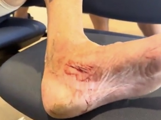 Newman’s injured foot after he was hit by his own drone. Picture: Instagram