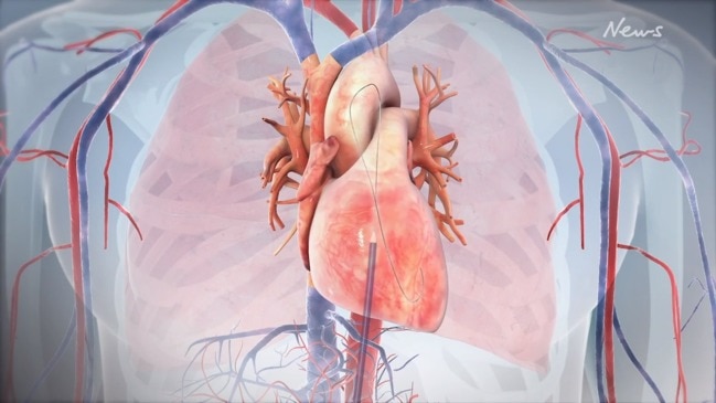 World first heart mitral valve procedure | news.com.au — Australia’s ...