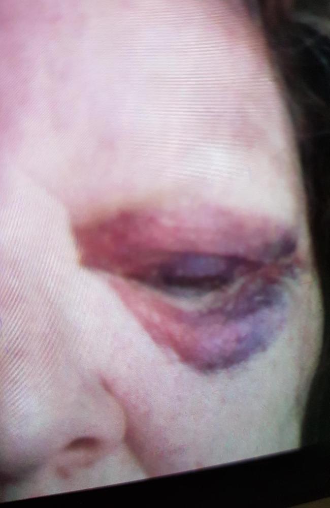 ‘Jodie’ was trying to help a patient at a Melbourne Hospital in 2017 when she was punched in the face by a patient, leaving her with an eye injury and PTSD.