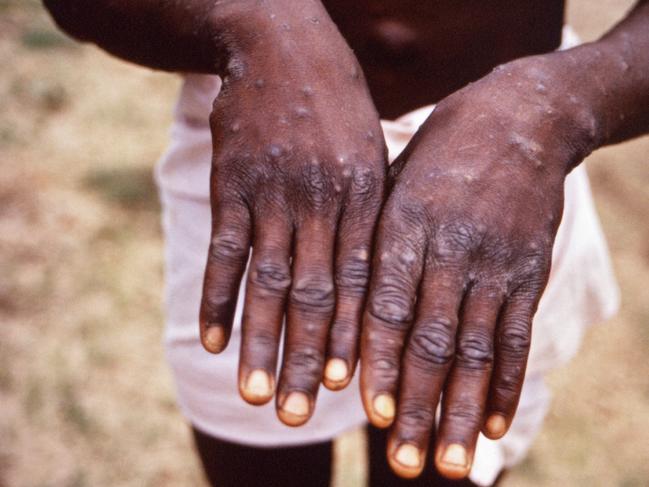 An example of monkeypox.