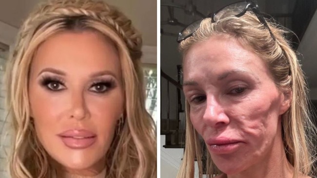 Brandi Glanville reveals facial disfuregment.