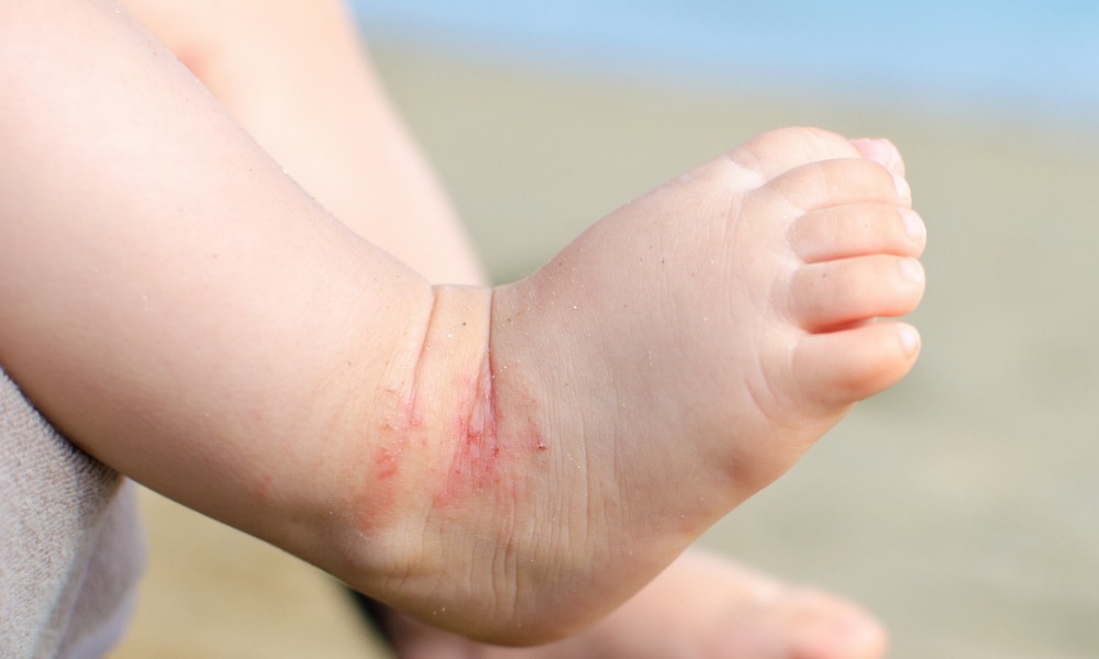 Sunscreen reactions: Allergy and sensitive skin symptoms kids |