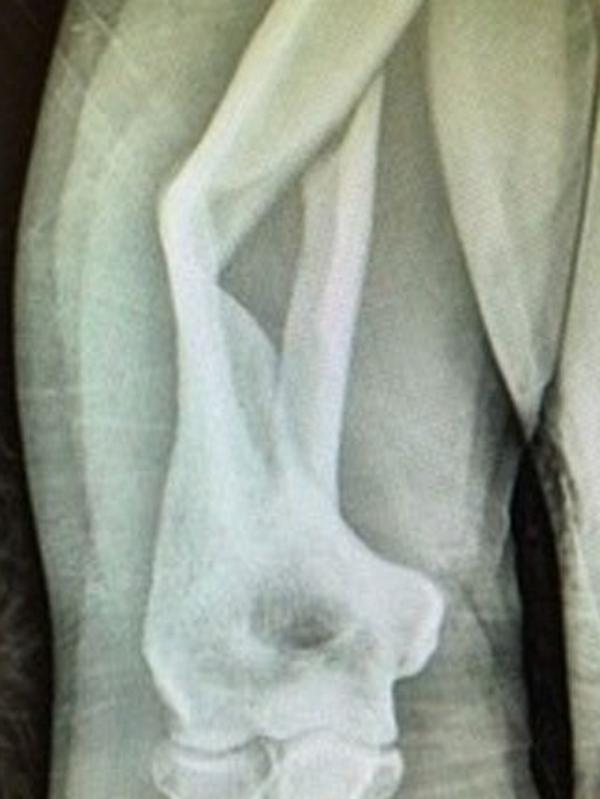 An X-ray of the break.