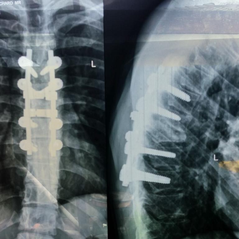 The X-ray showing Richard Davis’s fractured T6 verterbra. Picture: Supplied