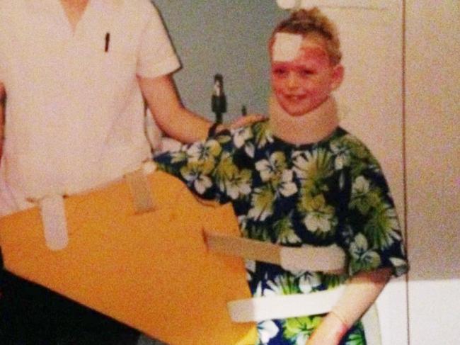 Ben Smith suffered 55 per cent burns to his body after he lit a fire that exploded when he was 8 years old. Picture: Supplied