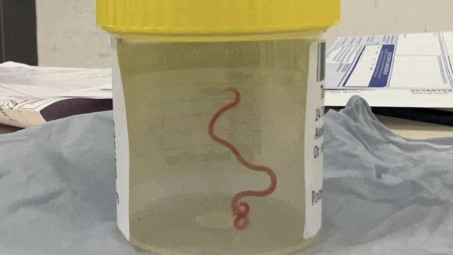 A roundworm was found in a 64-year-old woman's brain in the first-ever human case of Ophidascaris. Picture: Canberra Health
