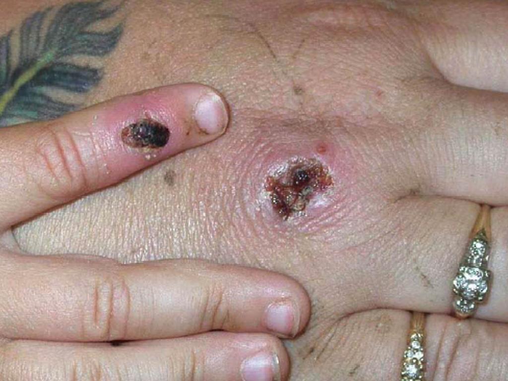 Symptoms of one of the first known cases of the monkeypox virus are shown on a patient. (Photo Courtesy of CDC/Getty Images)