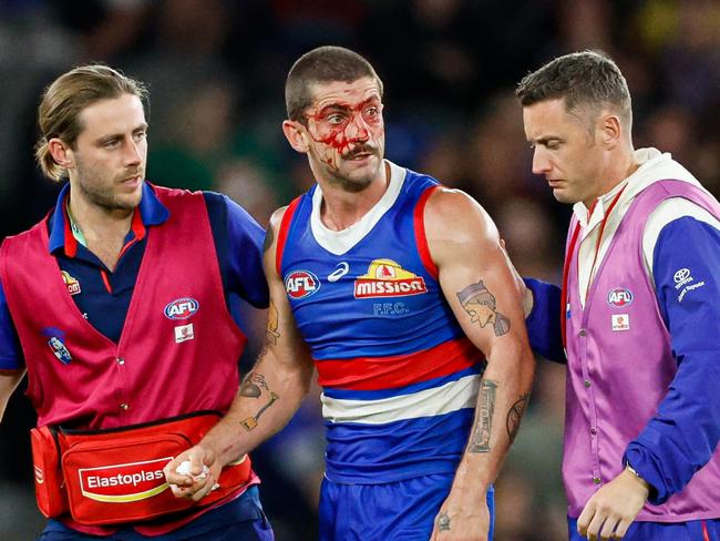 MELBOURNE, AUSTRALIA - MAY 05: Tom Liberatore of the Bulldogs leaves the field under the blood rule during the 2024 AFL Round 08 match between the Western Bulldogs and the Hawthorn Hawks at Marvel Stadium on May 05, 2024 in Melbourne, Australia. (Photo by Dylan Burns/AFL Photos via Getty Images)