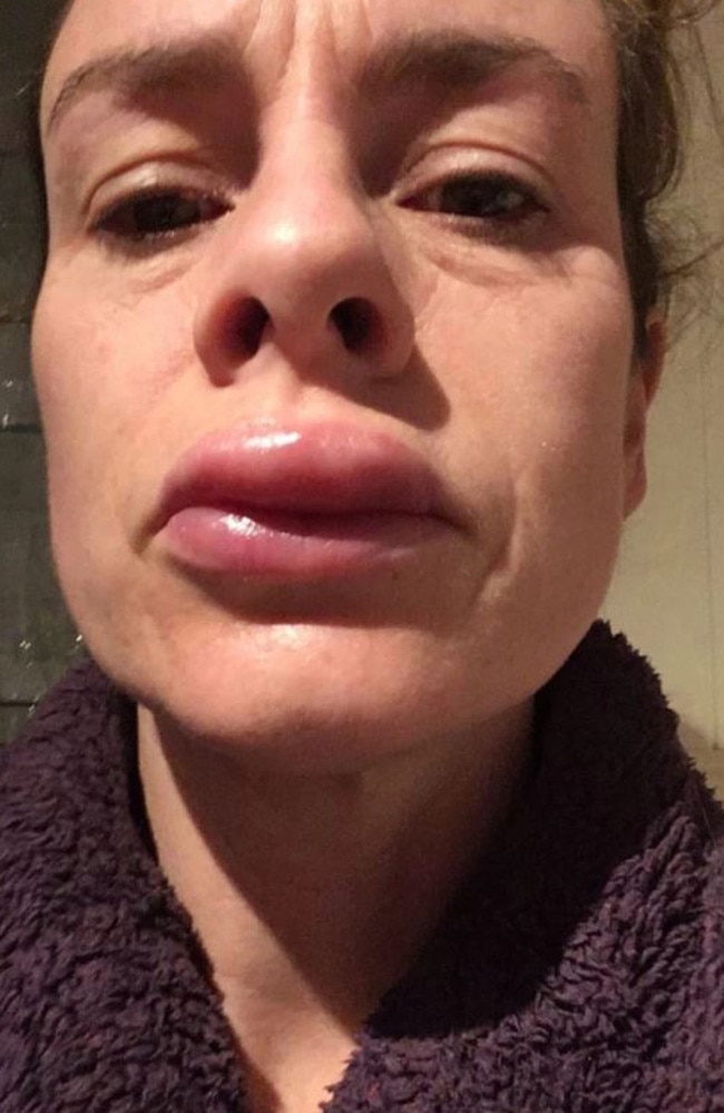 Mum Left With Swollen Lip After Buying Teeth Whitening Kit On Facebook 