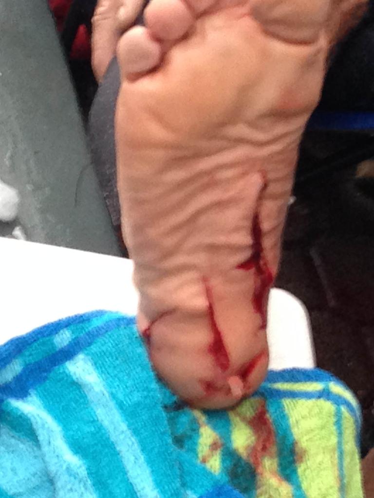 Gashes in Rowland’s foot. Picture: Roberto Gonzalez