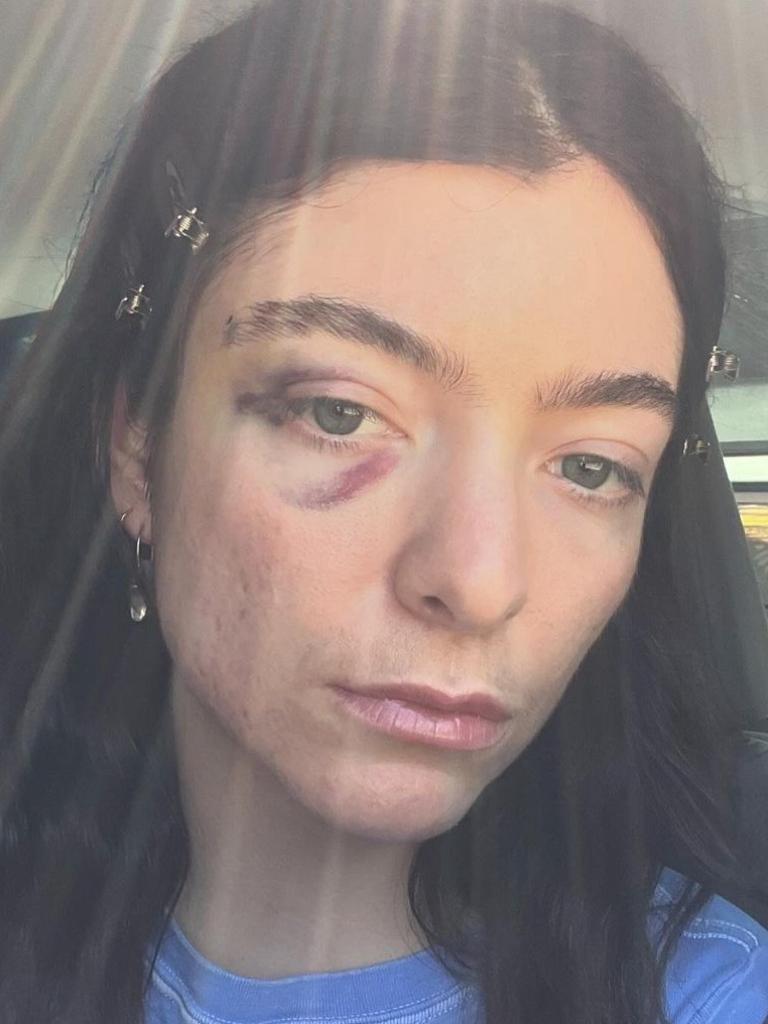 Lorde has shared several photos of herself sporting a black eye.