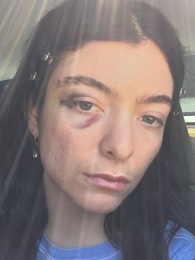 Lorde has shared several photos of herself sporting a black eye.
