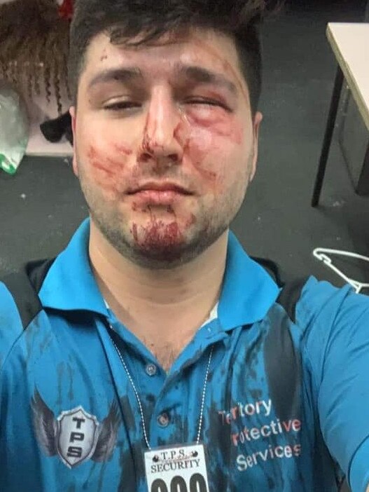 Jake Duncan’s bloodied and swollen face after the attack. He was taken to hospital with a broken eye socket. Picture: Supplied