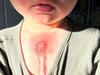 Boy’s ‘nasty’ lime burn sparks warning