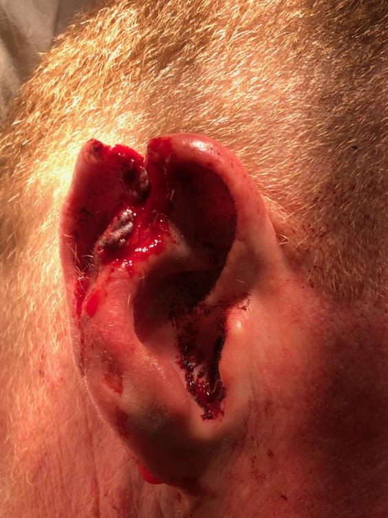 GRAPHIC WARNING: A South Lismore man has accused of biting the ear of an off-duty police officer, leaving him with significant injuries.