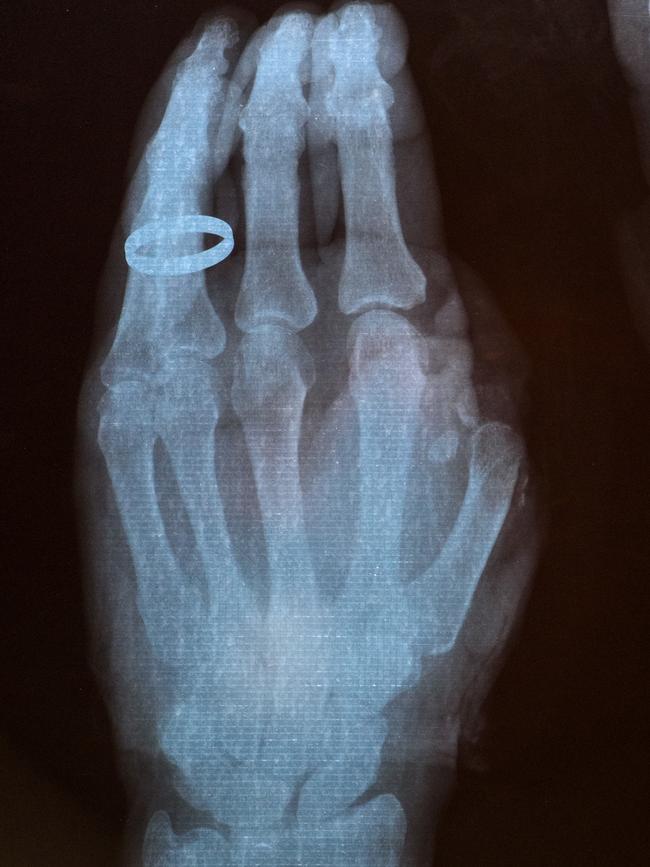 An x-ray of Bannan’s hand, minus his thumb, after the accident with a saw.